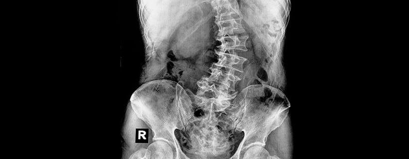 patient needing scoliosis chiropractor in ' . $businessCity . ' ' . $businessState . '