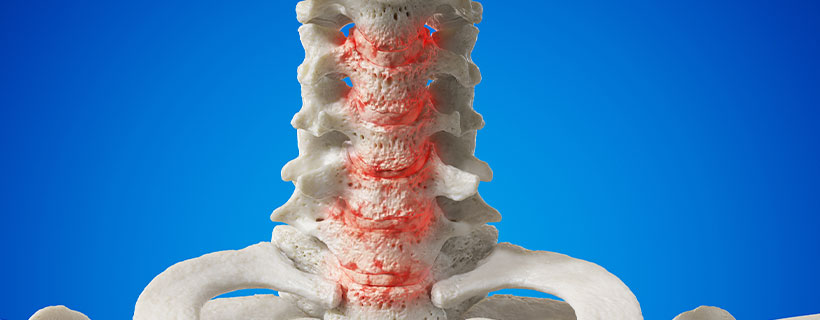 patient needing Spondylosis relief in Charlotte NC